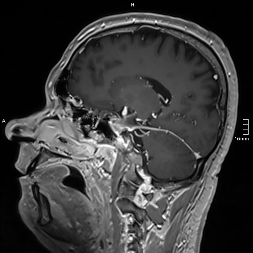 Neurosarcoidosis - involvement of the mesial temporal lobes (Radiopaedia 67429-76820 Sagittal T1 C+ 70).jpg