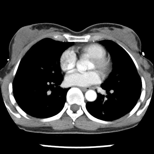 File:Non-small cell lung cancer with miliary metastases (Radiopaedia 23995-24193 A 25).jpg