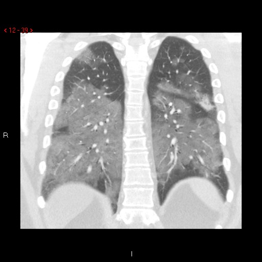 File:Non-specific interstitial pneumonitis (Radiopaedia 27044-27222 Coronal lung window 39).jpg