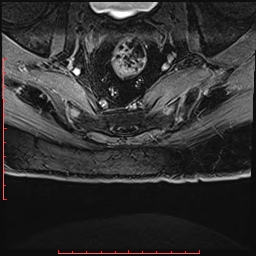 Non Hodgkin's lymphoma with metastasis to spine (Radiopaedia 54844-61103 Axial T1 C+ fat sat 47).jpg