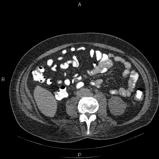 File:Non Hodgkin lymphoma in a patient with ankylosing spondylitis (Radiopaedia 84323-99624 Axial non-contrast 45).jpg