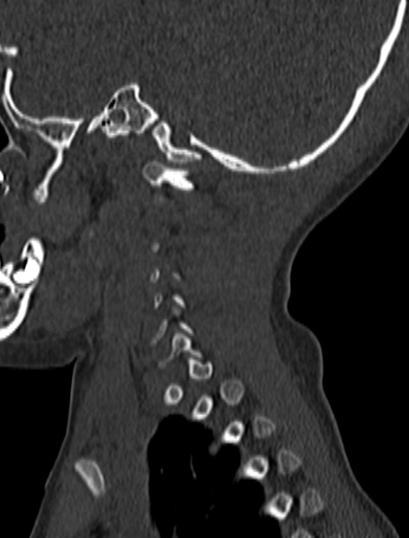 Normal CT cervical spine - pediatric (Radiopaedia 52549-58462 Sagittal bone window 20).jpg