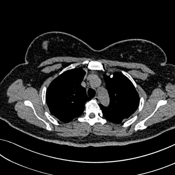 Normal CT chest- adult female (Radiopaedia 52522-58428 Axial non-contrast 36).jpg