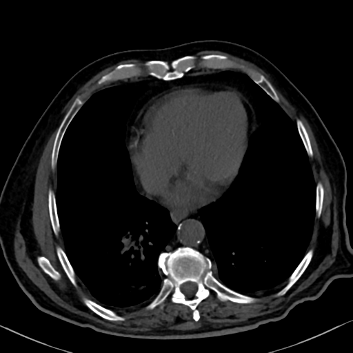 File:Normal CT intravenous cholangiogram (Radiopaedia 38199-40208 Axial IVC 7).png