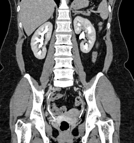 Normal CT intravenous urogram (Radiopaedia 39444-41759 A 300).jpg