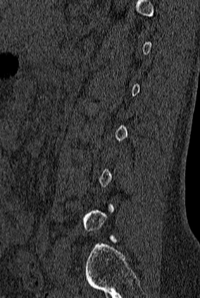 File:Normal CT lumbar spine (Radiopaedia 53981-60118 Sagittal bone window 71).jpg