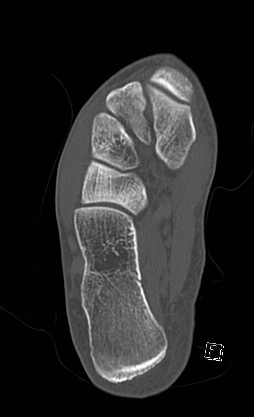 Normal CT of the ankle (Radiopaedia 47111-51658 Axial bone window 73).jpg
