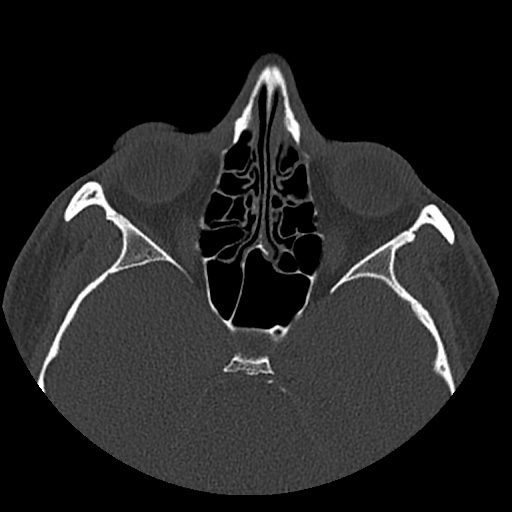 Normal CT paranasal sinuses (Radiopaedia 42286-45390 Axial bone window 51).jpg
