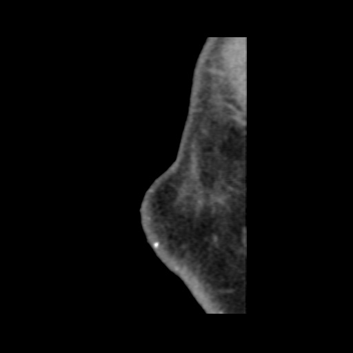Normal CT paranasal sinuses (Radiopaedia 42286-45390 F 142).jpg