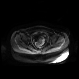 Normal MRI abdomen in pregnancy (Radiopaedia 88001-104541 Axial DWI 47).jpg