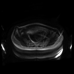 Normal MRI abdomen in pregnancy (Radiopaedia 88001-104541 Axial DWI 94).jpg