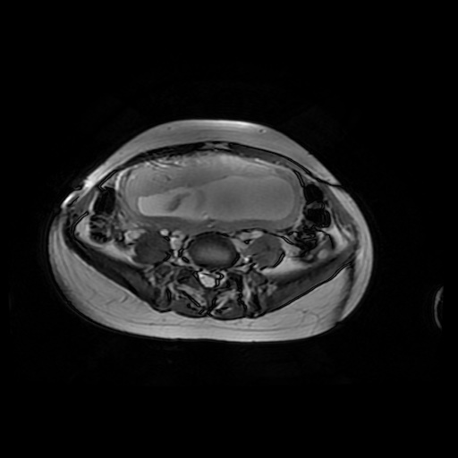 File:Normal MRI abdomen in pregnancy (Radiopaedia 88001-104541 Axial Gradient Echo 36).jpg