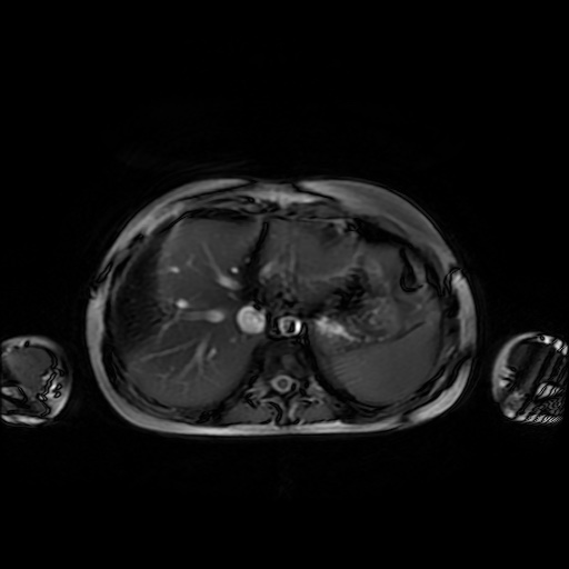 File:Normal MRI abdomen in pregnancy (Radiopaedia 88001-104541 Axial Gradient Echo 7).jpg