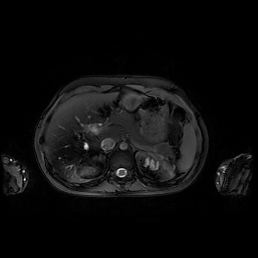 File:Normal MRI abdomen in pregnancy (Radiopaedia 88001-104541 D 13).jpg