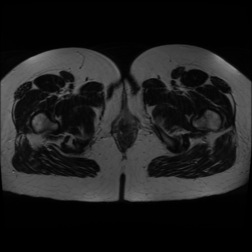 Normal MRI abdomen in pregnancy (Radiopaedia 88005-104548 Axial T2 54).jpg
