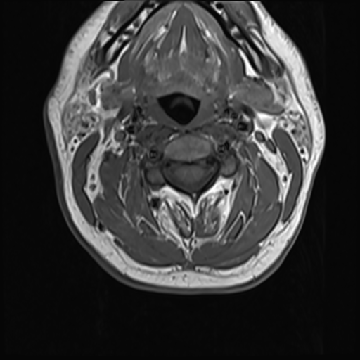 File:Normal MRI cervical spine (infection protocol) (Radiopaedia 53916-60039 Axial 19).png