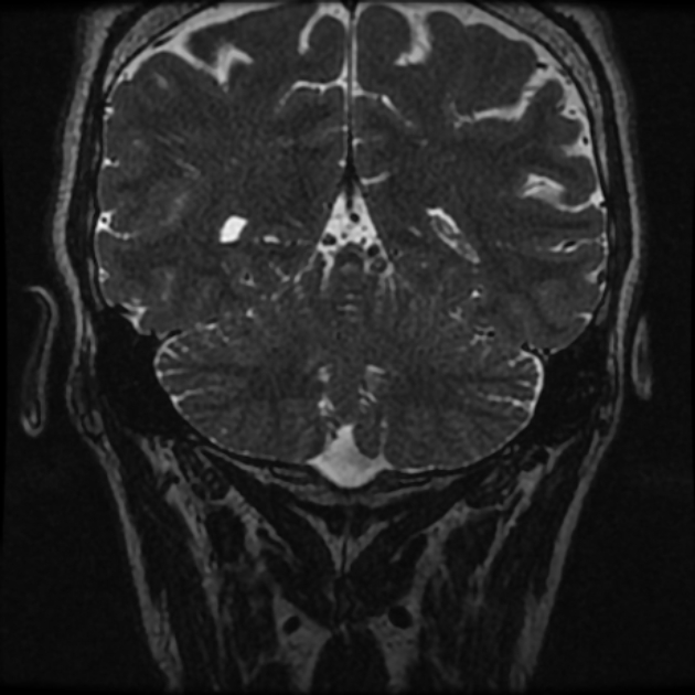 Normal MRI petrous (Radiopaedia 91317-108949 Coronal T2 107).jpg