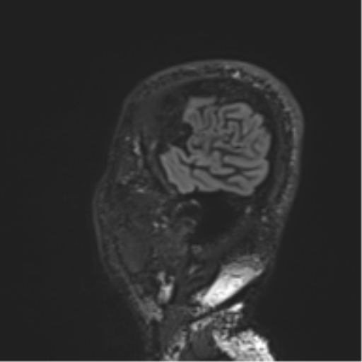 Normal brain MRI (non-focal epilepsy protocol) (Radiopaedia 53917-60040 Sagittal DIR 55).png