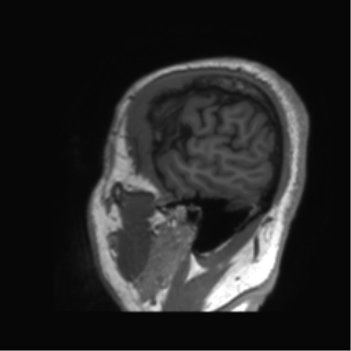 Normal brain MRI (non-focal epilepsy protocol) (Radiopaedia 53917-60040 Sagittal T1 64).png