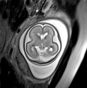 File:Normal brain fetal MRI - 22 weeks (Radiopaedia 50623-56050 Axial T2 Haste 6).jpg