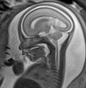Normal brain fetal MRI - 22 weeks (Radiopaedia 50623-56050 Sagittal T2 Haste 11).jpg