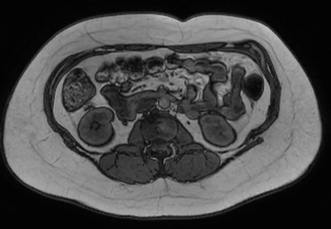 File:Normal liver MRI with Gadolinium (Radiopaedia 58913-66163 B 9).jpg