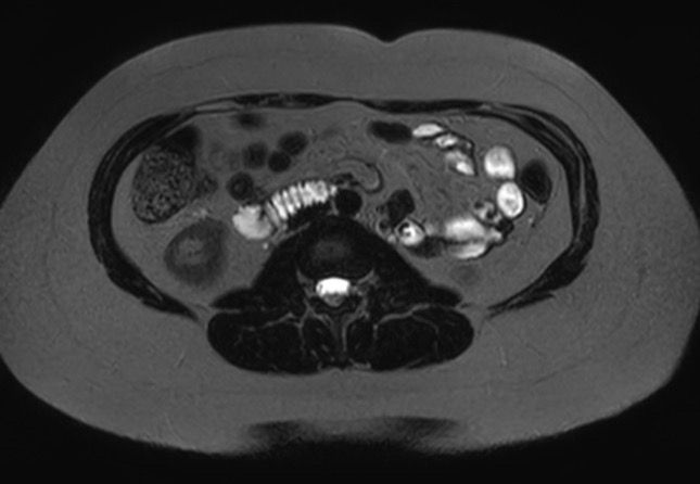 File:Normal liver MRI with Gadolinium (Radiopaedia 58913-66163 E 6).jpg