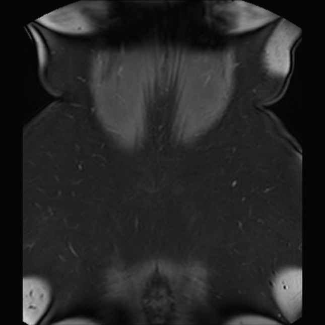 Normal liver MRI with Gadolinium (Radiopaedia 58913-66163 P 83).jpg