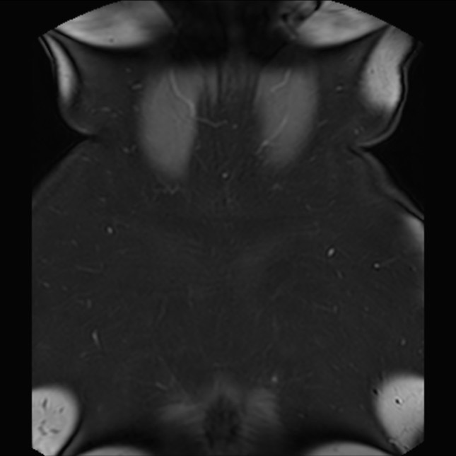 Normal liver MRI with Gadolinium (Radiopaedia 58913-66163 P 86).jpg