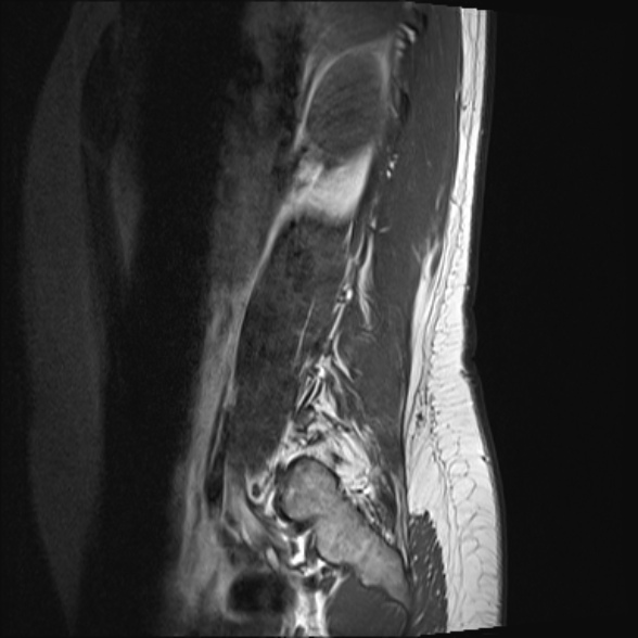 File:Normal lumbar spine MRI- 3 T (Radiopaedia 53280-59250 Sagittal T1 3).jpg