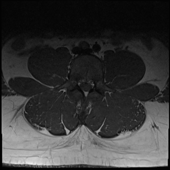 File:Normal lumbar spine MRI (Radiopaedia 47857-52609 Axial T1 12).jpg