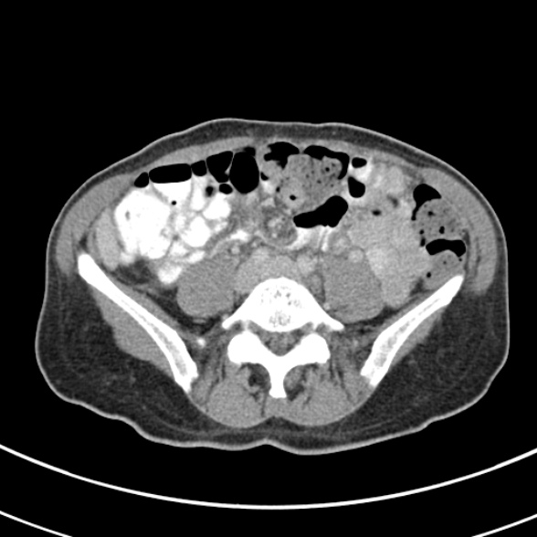 File:Normal multiphase CT liver (Radiopaedia 38026-39996 C 58).jpg
