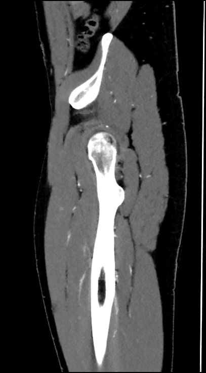Normal pelvis CT angiogram (Radiopaedia 84966-100481 C 19).jpg
