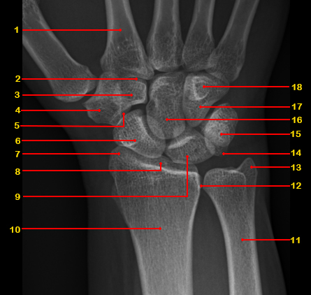 File:Normal radiographic anatomy of the wrist (Radiopaedia 43305-46649 AP 1).jpg