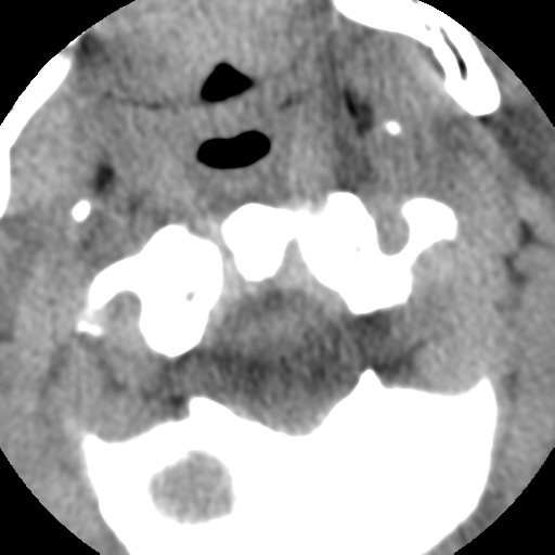 Normal trauma cervical spine (Radiopaedia 41017-43760 Axial non-contrast 14).png
