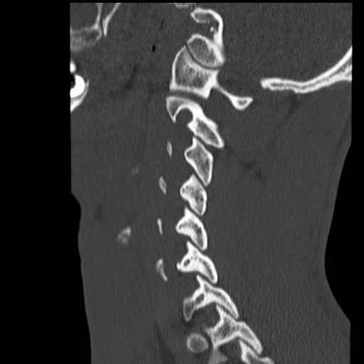 File:Normal trauma cervical spine (Radiopaedia 41017-43760 Sagittal bone window 34).png