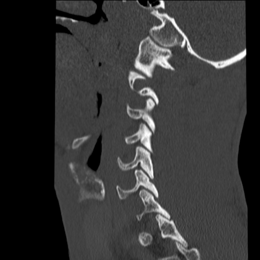 File:Normal trauma cervical spine (Radiopaedia 41017-43760 Sagittal bone window 8).png