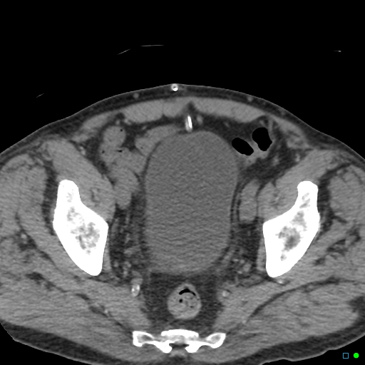 File:Obstructed Tenckhoff peritoneal dialysis catheter (Radiopaedia 37858-39789 Axial non-contrast 8).jpg