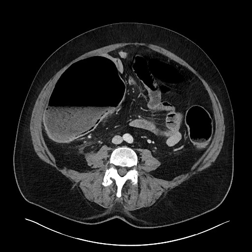 Obstructing sigmoid adenocarcinoma (Radiopaedia 58465-65619 A 101).jpg