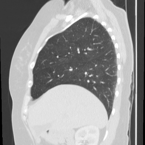 Obstructing typical carcinoid causing bronchoceles (Radiopaedia 50149-55476 Sagittal lung window 17).png