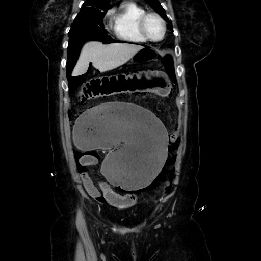 Obstructive distal colonic adenocarcinoma causing cecal perforation (Radiopaedia 86830-102989 C 65).jpg