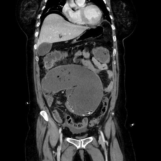 Obstructive distal colonic adenocarcinoma causing cecal perforation (Radiopaedia 86830-102989 C 75).jpg