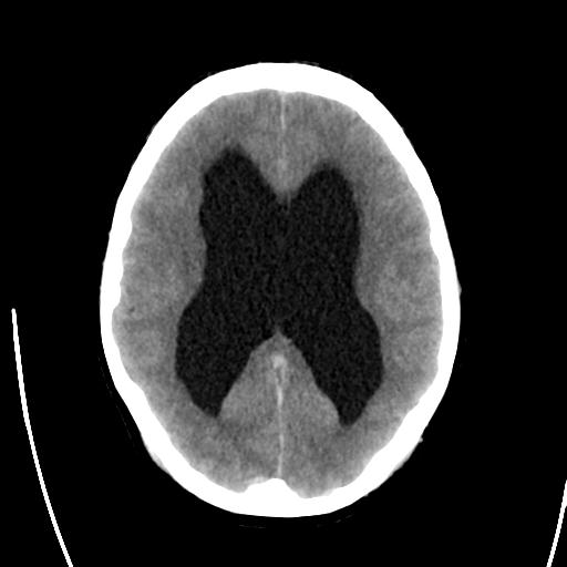 File:Obstructive hydrocephalus (Radiopaedia 30453-31119 Axial non-contrast 16).jpg
