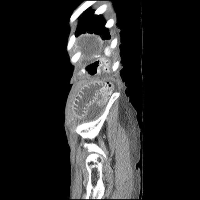 Obturator hernia causing small bowel obstruction (Radiopaedia 65522-74612 C 10).jpg