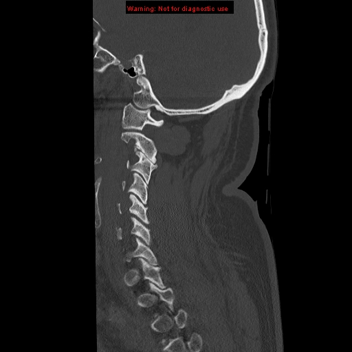 File:Occipital condyle fracture (Radiopaedia 18366-18208 Sagittal bone window 9).jpg
