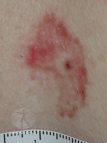 File:Superficial basal cell carcinoma (DermNet NZ procedures-sup-bcc).jpg