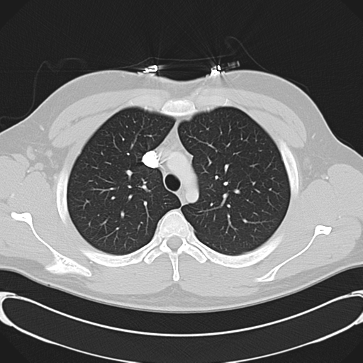 'Bovine' aortic arch (Radiopaedia 33554-34637 Axial lung window 17).png
