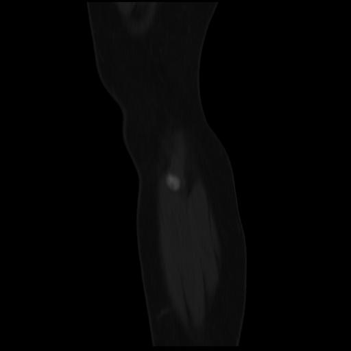 File:ACL avulsion fracture (Radiopaedia 33833-34994 Sagittal bone window 1).jpg