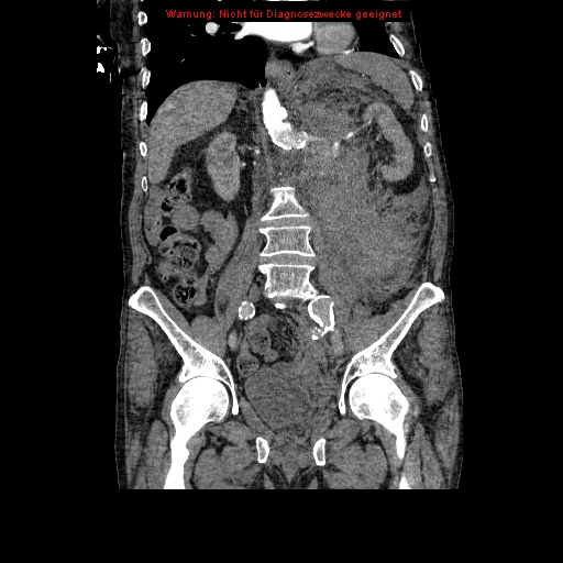 Abdominal aortic aneurysm- extremely large, ruptured (Radiopaedia 19882-19921 Coronal C+ arterial phase 59).jpg