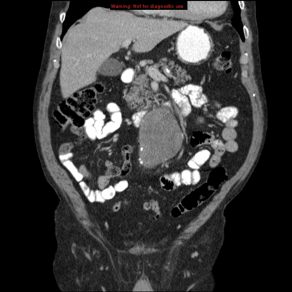 File:Abdominal aortic aneurysm (Radiopaedia 10122-10660 Coronal C+ portal venous phase 9).jpg